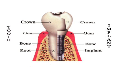 Dental Implants in Woodland Hills
