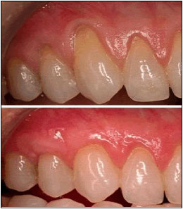 Gum Grafting Before & After