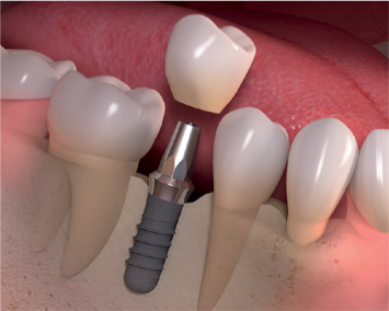 Dental Implants in Woodland Hills
